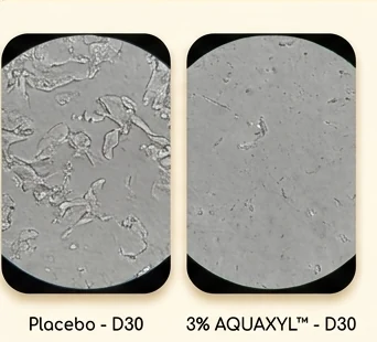 Tình trạng bong vảy ngày 30: placebo so với AQUAXYL
