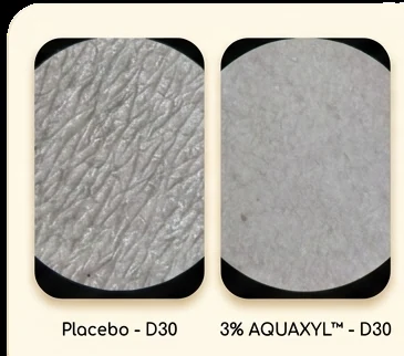 Bề mặt da ngày 30: placebo so với AQUAXYL